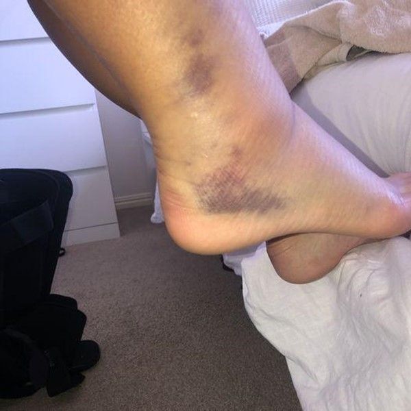 eczema & 3rd degree ankle sprain - success story: selu maama