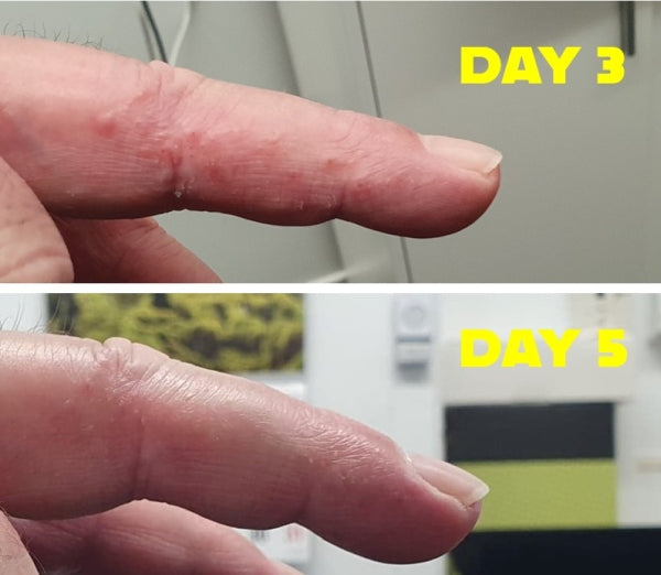 eczema - success story: matiu